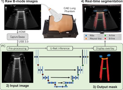 Workflow diagram showing real-time lung ultrasound segmentation with U-Net. Images available for republishing under Creative Commons license (CC BY 4.0 DEED, Attribution 4.0 International) and courtesy of Ultrasonics.