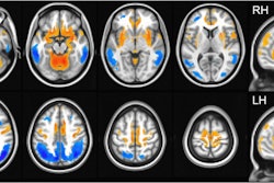 DLB-hypo (hypometabolic changes in dementia with Lewy bodies) was characterized by relatively reduced bilateral metabolic activity (color-coded blue) in the bilateral parietal, temporal, and occipital cortices, while DLB-hyper (hypermetabolic changes in dementia with Lewy bodies) showed relatively increased metabolic activity (color-coded red) in the cerebellum, bilateral sensorimotor, orbitofrontal, insular, and parahippocampal cortices, bilateral putamen, globus pallidum, hippocampus, and amygdala. Image courtesy of npj Parkinson’s Disease.