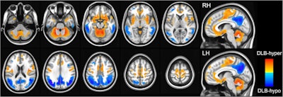 DLB-hypo (hypometabolic changes in dementia with Lewy bodies) was characterized by relatively reduced bilateral metabolic activity (color-coded blue) in the bilateral parietal, temporal, and occipital cortices, while DLB-hyper (hypermetabolic changes in dementia with Lewy bodies) showed relatively increased metabolic activity (color-coded red) in the cerebellum, bilateral sensorimotor, orbitofrontal, insular, and parahippocampal cortices, bilateral putamen, globus pallidum, hippocampus, and amygdala. Image courtesy of npj Parkinson’s Disease.