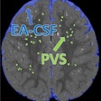 Extra-axial cerebrospinal fluid (EA-CSF) and perivascular space (PVS) segmentation on a 24-month scan of a child who was diagnosed with autism. Image courtesy of Dea Garic, PhD, and Mark Shen, PhD.