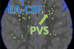 Extra-axial cerebrospinal fluid (EA-CSF) and perivascular space (PVS) segmentation on a 24-month scan of a child who was diagnosed with autism. Image courtesy of Dea Garic, PhD, and Mark Shen, PhD.