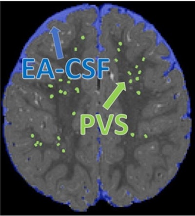 Extra-axial cerebrospinal fluid (EA-CSF) and perivascular space (PVS) segmentation on a 24-month scan of a child who was diagnosed with autism. Image courtesy of Dea Garic, PhD, and Mark Shen, PhD.