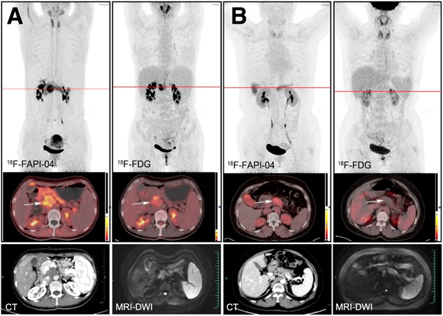 Typical PET (top), PET/CT (middle), and CT and MR (bottom) images of primary tumor obtained using both radiotracers in representative patients (A and B). Tumor is marked by arrows. DWI = diffusion-weighted imaging. Image courtesy of the Journal of Nuclear Medicine.