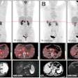 Typical PET (top), PET/CT (middle), and CT and MR (bottom) images of primary tumor obtained using both radiotracers in representative patients (A and B). Tumor is marked by arrows. DWI = diffusion-weighted imaging. Image courtesy of the Journal of Nuclear Medicine.