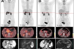 Typical PET (top), PET/CT (middle), and CT and MR (bottom) images of primary tumor obtained using both radiotracers in representative patients (A and B). Tumor is marked by arrows. DWI = diffusion-weighted imaging. Image courtesy of the Journal of Nuclear Medicine.