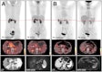 Typical PET (top), PET/CT (middle), and CT and MR (bottom) images of primary tumor obtained using both radiotracers in representative patients (A and B). Tumor is marked by arrows. DWI = diffusion-weighted imaging. Image courtesy of the Journal of Nuclear Medicine.