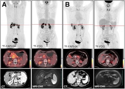 Typical PET (top), PET/CT (middle), and CT and MR (bottom) images of primary tumor obtained using both radiotracers in representative patients (A and B). Tumor is marked by arrows. DWI = diffusion-weighted imaging. Image courtesy of the Journal of Nuclear Medicine.