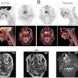 PET/CT and MR images of a 72-year-old woman. (A) F-18 FDG-PET images (left and top) and PET/CT images (bottom) shown in coronal, sagittal, and axial views (from left to right), demonstrated a metastatic lymph node of the right neck with intensive metabolic activity (black arrow, SUVmax, 30.1) but presented no evidence for primary tumor. (B) Ga-68 FAPI-PET images (top and right) and PET/CT images (bottom), shown in axial, sagittal, and coronal views (from left to right), also detected metastatic lymph node with high Ga-68 FAPI tracer activity (black arrow, SUVmax, 16.3). There was intensive uptake of Ga-68 FAPI in palate (red arrow, SUVmax, 11.3). (C) T1-weighted, T2-weighted, and contrast-enhanced T1-weighted MRI also presented no evidence for primary tumor. Subsequent surgery confirmed mucoepidermoid carcinoma of palate. Image courtesy of the Journal of Nuclear Medicine.