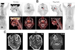 PET/CT and MR images of a 72-year-old woman. (A) F-18 FDG-PET images (left and top) and PET/CT images (bottom) shown in coronal, sagittal, and axial views (from left to right), demonstrated a metastatic lymph node of the right neck with intensive metabolic activity (black arrow, SUVmax, 30.1) but presented no evidence for primary tumor. (B) Ga-68 FAPI-PET images (top and right) and PET/CT images (bottom), shown in axial, sagittal, and coronal views (from left to right), also detected metastatic lymph node with high Ga-68 FAPI tracer activity (black arrow, SUVmax, 16.3). There was intensive uptake of Ga-68 FAPI in palate (red arrow, SUVmax, 11.3). (C) T1-weighted, T2-weighted, and contrast-enhanced T1-weighted MRI also presented no evidence for primary tumor. Subsequent surgery confirmed mucoepidermoid carcinoma of palate. Image courtesy of the Journal of Nuclear Medicine.