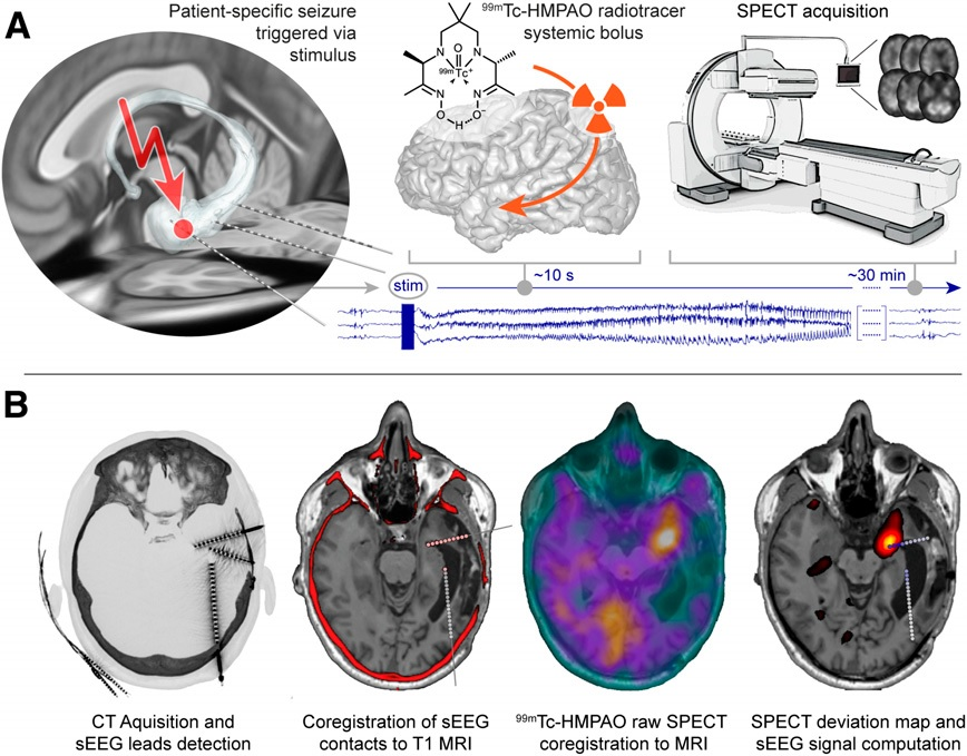 Schematic of triggered ictal SPECT and data processing. (A) Previously screened and selected sEEG bipolar contact is stimulated to trigger patient-typical seizure. Directly after seizure onset, confirmed through sEEG signals and semiology, systemic bolus of radiotracer (Tc-99m HMPAO) is administered. Planned SPECT is acquired within less than one hour. (B) Raw data processing from left to right (dataset from participant three as example). Postimplantation CT and preimplantation T1-weighted MRI are coregistered for sEEG lead localization. Raw SPECT images are coregistered to T1-weighted MRI sequence. SPECT deviation map is computed and anatomically colocalized with sEEG signals. Image courtesy of the Journal of Nuclear Medicine.