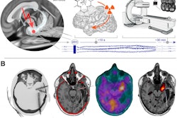 Schematic of triggered ictal SPECT and data processing. (A) Previously screened and selected sEEG bipolar contact is stimulated to trigger patient-typical seizure. Directly after seizure onset, confirmed through sEEG signals and semiology, systemic bolus of radiotracer (Tc-99m HMPAO) is administered. Planned SPECT is acquired within less than one hour. (B) Raw data processing from left to right (dataset from participant three as example). Postimplantation CT and preimplantation T1-weighted MRI are coregistered for sEEG lead localization. Raw SPECT images are coregistered to T1-weighted MRI sequence. SPECT deviation map is computed and anatomically colocalized with sEEG signals. Image courtesy of the Journal of Nuclear Medicine.