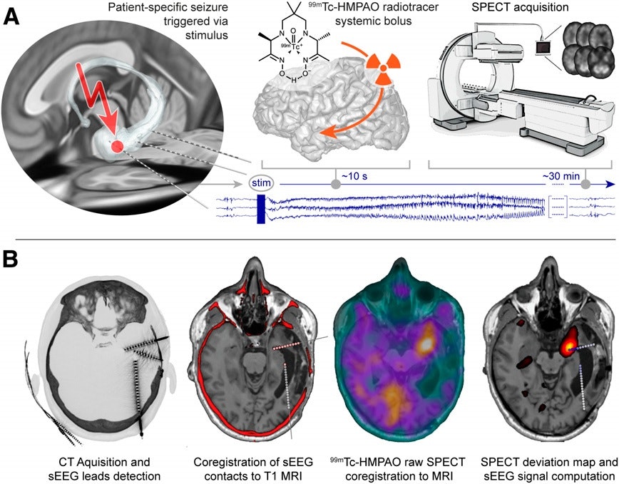 Can ictal SPECT make a comeback in epilepsy patients? | AuntMinnie