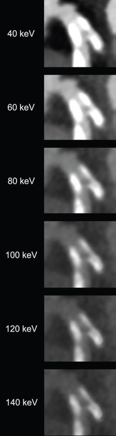82-year-old man with calcified stenosis in left main artery who underwent coronary CTA by PCCT. Curved multiplanar reformatted images at varying virtual monoenergetic imaging (VMI) levels (40-140 keV) show stenosis at each level. Percent diameter stenosis (PDS) decreased from 92.5% at 40 keV to 53.1% at 140 keV. Extent of calcium blooming artifacts decreased from 100% at 40 keV to 72.3% at 140 keV. Image and caption courtesy of the American Journal of Roentgenology.