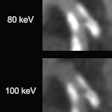 82-year-old man with calcified stenosis in left main artery who underwent coronary CTA by PCCT. Curved multiplanar reformatted images at varying virtual monoenergetic imaging (VMI) levels (40-140 keV) show stenosis at each level. Percent diameter stenosis (PDS) decreased from 92.5% at 40 keV to 53.1% at 140 keV. Extent of calcium blooming artifacts decreased from 100% at 40 keV to 72.3% at 140 keV. Image and caption courtesy of the American Journal of Roentgenology.
