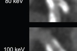 82-year-old man with calcified stenosis in left main artery who underwent coronary CTA by PCCT. Curved multiplanar reformatted images at varying virtual monoenergetic imaging (VMI) levels (40-140 keV) show stenosis at each level. Percent diameter stenosis (PDS) decreased from 92.5% at 40 keV to 53.1% at 140 keV. Extent of calcium blooming artifacts decreased from 100% at 40 keV to 72.3% at 140 keV. Image and caption courtesy of the American Journal of Roentgenology.
