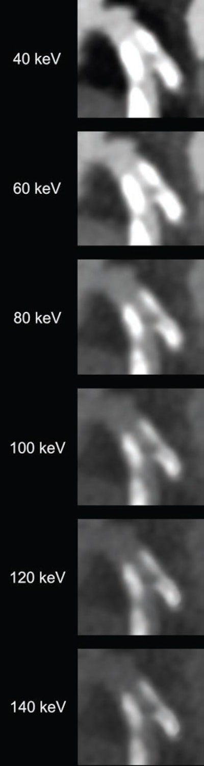82-year-old man with calcified stenosis in left main artery who underwent coronary CTA by PCCT. Curved multiplanar reformatted images at varying virtual monoenergetic imaging (VMI) levels (40-140 keV) show stenosis at each level. Percent diameter stenosis (PDS) decreased from 92.5% at 40 keV to 53.1% at 140 keV. Extent of calcium blooming artifacts decreased from 100% at 40 keV to 72.3% at 140 keV. Image and caption courtesy of the American Journal of Roentgenology.