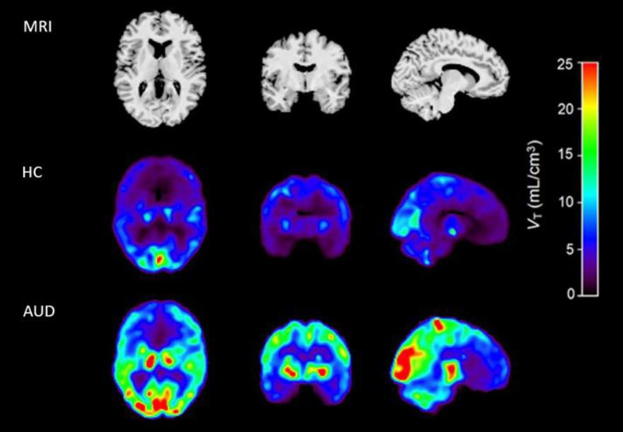 MRI (top panel) and coregistered F-18 AS2471907 PET images of a healthy control (middle panel) and an age- and sex-matched individual with AUD (bottom panel). Image courtesy of Neurobiology of Stress.