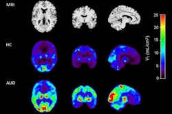 MRI (top panel) and coregistered F-18 AS2471907 PET images of a healthy control (middle panel) and an age- and sex-matched individual with AUD (bottom panel). Image courtesy of Neurobiology of Stress.