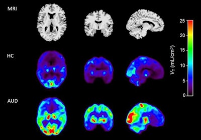 MRI (top panel) and coregistered F-18 AS2471907 PET images of a healthy control (middle panel) and an age- and sex-matched individual with AUD (bottom panel). Image courtesy of Neurobiology of Stress.