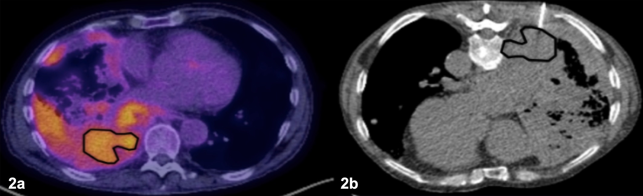 Patient with extensive lung and pleural disease. (2a) The PET/CT was available prior to the biopsy showing heterogeneous F-18 FDG radiotracer uptake and delineating the most accessible area of increased metabolic activity. (2b) The biopsy was targeted to the area of increased activity area and was positive for malignant diagnosis. Image courtesy of the European Journal of Radiology.