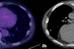 Patient with extensive lung and pleural disease. (2a) The PET/CT was available prior to the biopsy showing heterogeneous F-18 FDG radiotracer uptake and delineating the most accessible area of increased metabolic activity. (2b) The biopsy was targeted to the area of increased activity area and was positive for malignant diagnosis. Image courtesy of the European Journal of Radiology.