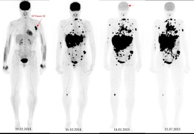 A 49-year-old patient with primary clinical stage III melanoma underwent F-18 FDG-PET. The primary tumor Breslow thickness was 6.5 mm. On initial F-18 FDG-PET images, this patient had a high SUVmax (52), resulting in limited survival with the occurrence of brain metastasis in the first year of follow-up (horizontal arrow). Notably, during the course of the treatment, the patient underwent surgical removal of the primary tumor as well as lymph node dissection, followed by neoadjuvant radiotherapy and immunotherapy. Image courtesy of Cancers.