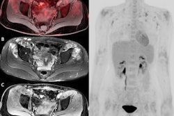 In an example image from the study, F-18 FDG-PET/MRI fusion image (A) and PET 3D image (D) show a moderately increased FDG uptake in muscles around hip joints. T2 IDEAL WATER image (B) shows increased T2 signal; LAVA WATER (C) image shows mild enhancement in these muscles. Findings were suspicious of myositis, which was histopathologically confirmed. Image courtesy of the European Journal of Radiology.