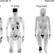 Representative Ga-68 FAPI-04 and F-18 FDG-PET/CT images of responders at three month follow-up. Patient #11 was a 50-year-old man with 28 affected joints detected in PET/CT. Joint activity decreased after treatment with Tripterygium wilfordii, methotrexate, adalimumab, and prednisone. In patient #8 (a 65-year-old woman), Ga-68 FAPI-04 PET/CT showed 12 affected joints. Joint activity decreased from baseline after three months of treatment with Tripterygium wilfordii and methotrexate.