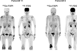 Representative Ga-68 FAPI-04 and F-18 FDG-PET/CT images of responders at three month follow-up. Patient #11 was a 50-year-old man with 28 affected joints detected in PET/CT. Joint activity decreased after treatment with Tripterygium wilfordii, methotrexate, adalimumab, and prednisone. In patient #8 (a 65-year-old woman), Ga-68 FAPI-04 PET/CT showed 12 affected joints. Joint activity decreased from baseline after three months of treatment with Tripterygium wilfordii and methotrexate.