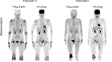 Representative Ga-68 FAPI-04 and F-18 FDG-PET/CT images of responders at three month follow-up. Patient #11 was a 50-year-old man with 28 affected joints detected in PET/CT. Joint activity decreased after treatment with Tripterygium wilfordii, methotrexate, adalimumab, and prednisone. In patient #8 (a 65-year-old woman), Ga-68 FAPI-04 PET/CT showed 12 affected joints. Joint activity decreased from baseline after three months of treatment with Tripterygium wilfordii and methotrexate.