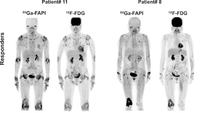 Representative Ga-68 FAPI-04 and F-18 FDG-PET/CT images of responders at three month follow-up. Patient #11 was a 50-year-old man with 28 affected joints detected in PET/CT. Joint activity decreased after treatment with Tripterygium wilfordii, methotrexate, adalimumab, and prednisone. In patient #8 (a 65-year-old woman), Ga-68 FAPI-04 PET/CT showed 12 affected joints. Joint activity decreased from baseline after three months of treatment with Tripterygium wilfordii and methotrexate.