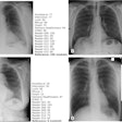 Example chest x-rays from a public test set illustrate algorithm and reader similarities to and discrepancies from the reference standard. A specialized radiologist determined the reference standard score (0, no nodule present; 100, one or more nodules present), and algorithms and human readers provided a probability score between 0 and 100 for each patient of the likelihood that the patient was a nodule case. (A) Radiograph in a man (age, 72 years) with a nodule present (reference standard score, 100) shows a true-positive result based on the average algorithm scores. (B) Radiograph in a man (age, 68 years) without a nodule present (reference standard score, 0) shows a true-negative result based on the average algorithm scores. (C) Radiograph in a woman (age, 64 years) without a nodule present (reference standard score, 0) shows a false-positive result based on the average algorithm scores. (D) Radiograph in a man (age, 37 years) with a nodule present (reference standard score, 100) shows a false-negative result based on the average algorithm scores. Corresponding lateral images and CT scans (when available) for these patients are presented in Figure S2 (supplementary data). The images shown in this figure were part of a public subset and not part of the set on which metrics are reported, which remains confidential for reevaluation in the future. Algorithm scores provided for the images are raw, uncalibrated scores and cannot be directly compared to each other; they are provided for indicative purposes only. Image and caption courtesy of Radiology.