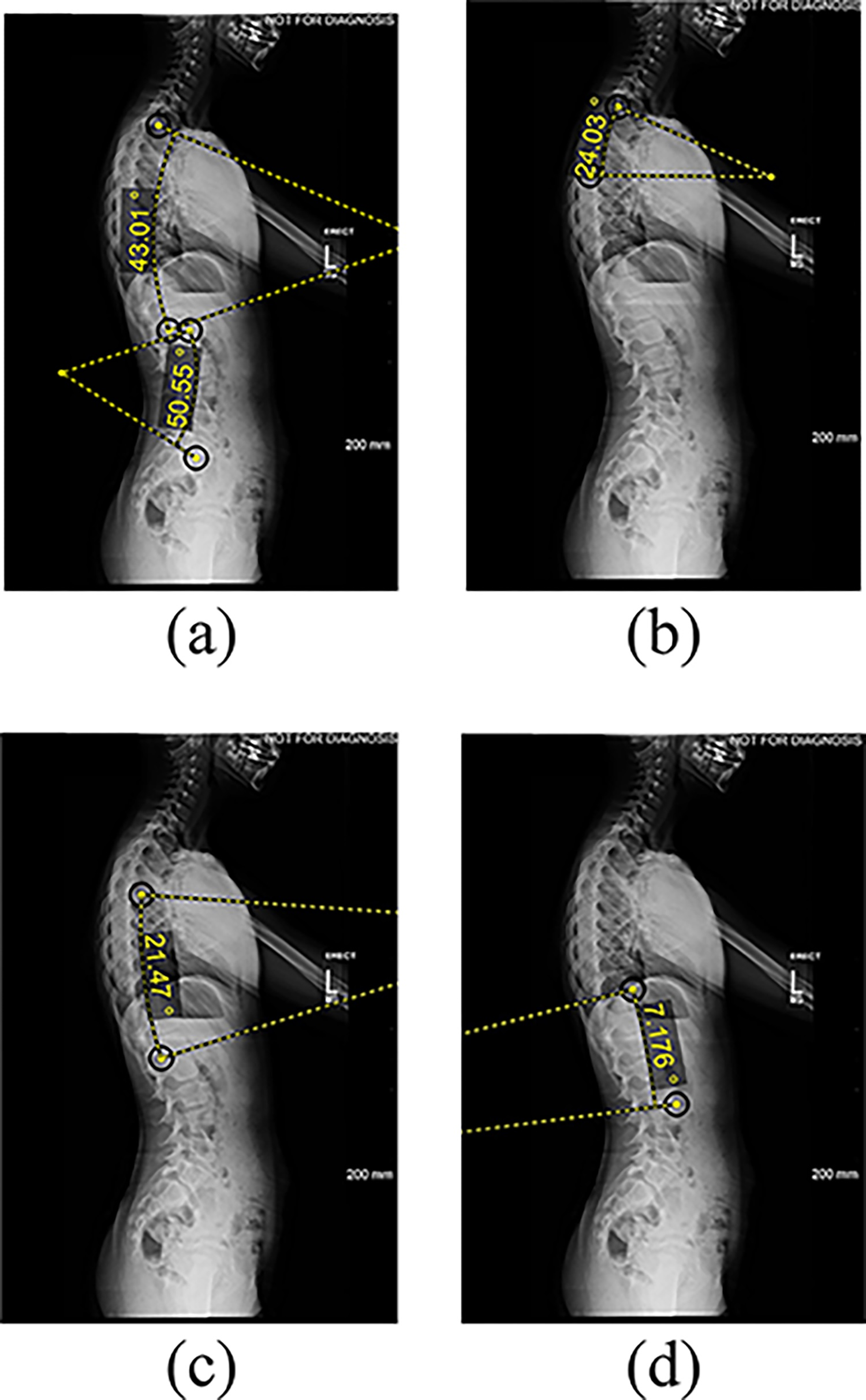 Features extracted from lateral radiographs. (a) thoracic kyphosis and lumbar lordosis (b) proximal thoracic kyphosis (c) mid-lower thoracic kyphosis (d) thoracolumbar lordosis angle measured between the superior endplate and the inferior endplate of the vertebral levels: T2-T12, L1-L5, T2-T5, T5-T12, and T12-L2. Image courtesy of PLOS One.