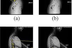 Features extracted from lateral radiographs. (a) thoracic kyphosis and lumbar lordosis (b) proximal thoracic kyphosis (c) mid-lower thoracic kyphosis (d) thoracolumbar lordosis angle measured between the superior endplate and the inferior endplate of the vertebral levels: T2-T12, L1-L5, T2-T5, T5-T12, and T12-L2. Image courtesy of PLOS One.