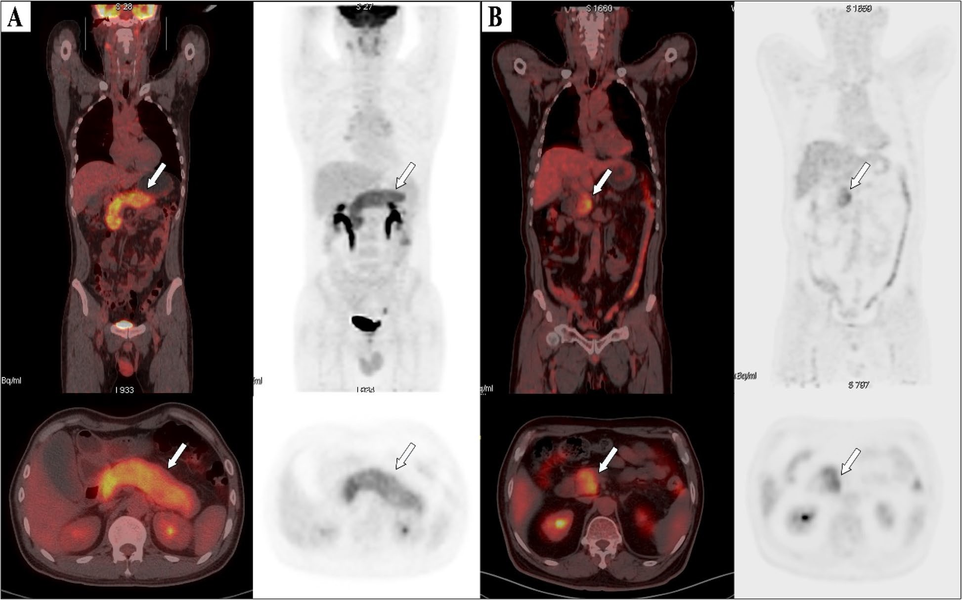 F-18 FDG-PET/CT images of patients. (A) Image of a 61-year-old male patient with type 1 autoimmune pancreatitis (AIP) demonstrating diffuse enlargement of the pancreas (arrows). The serum IgG4 level was 2,260.0 mg/dL, and the TLG2.5 was 413.8 g/ml&times;cm3. According to the nomogram, his relapse probability is more than 95%. The patient discontinued steroid use during the maintenance phase, and 7 months later, he relapsed, with imaging showing diffuse re-enlargement of the pancreas. (B) Image of a 60-year-old male patient with type 1 AIP, showing focal enlargement in the head of the pancreas (arrows). The serum IgG4 level was 980 mg/dL, and the TLG2.5 was 92.7.0 g/ml&times;cm3. According to the nomogram, the patient&rsquo;s relapse probability is less than 50%. After symptom relief, the patient did not receive maintenance treatment, and has been followed up for 4 years without relapse. Image courtesy of BMC Gastroenterology.
