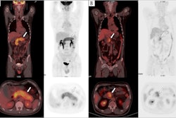 F-18 FDG-PET/CT images of patients. (A) Image of a 61-year-old male patient with type 1 autoimmune pancreatitis (AIP) demonstrating diffuse enlargement of the pancreas (arrows). The serum IgG4 level was 2,260.0 mg/dL, and the TLG2.5 was 413.8 g/ml×cm3. According to the nomogram, his relapse probability is more than 95%. The patient discontinued steroid use during the maintenance phase, and 7 months later, he relapsed, with imaging showing diffuse re-enlargement of the pancreas. (B) Image of a 60-year-old male patient with type 1 AIP, showing focal enlargement in the head of the pancreas (arrows). The serum IgG4 level was 980 mg/dL, and the TLG2.5 was 92.7.0 g/ml×cm3. According to the nomogram, the patient’s relapse probability is less than 50%. After symptom relief, the patient did not receive maintenance treatment, and has been followed up for 4 years without relapse. Image courtesy of BMC Gastroenterology.