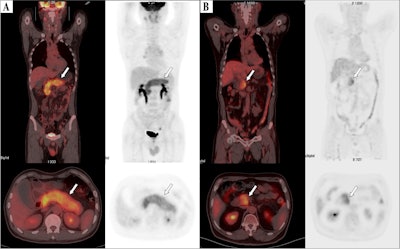 F-18 FDG-PET/CT images of patients. (A) Image of a 61-year-old male patient with type 1 autoimmune pancreatitis (AIP) demonstrating diffuse enlargement of the pancreas (arrows). The serum IgG4 level was 2,260.0 mg/dL, and the TLG2.5 was 413.8 g/ml×cm3. According to the nomogram, his relapse probability is more than 95%. The patient discontinued steroid use during the maintenance phase, and 7 months later, he relapsed, with imaging showing diffuse re-enlargement of the pancreas. (B) Image of a 60-year-old male patient with type 1 AIP, showing focal enlargement in the head of the pancreas (arrows). The serum IgG4 level was 980 mg/dL, and the TLG2.5 was 92.7.0 g/ml×cm3. According to the nomogram, the patient’s relapse probability is less than 50%. After symptom relief, the patient did not receive maintenance treatment, and has been followed up for 4 years without relapse. Image courtesy of BMC Gastroenterology.