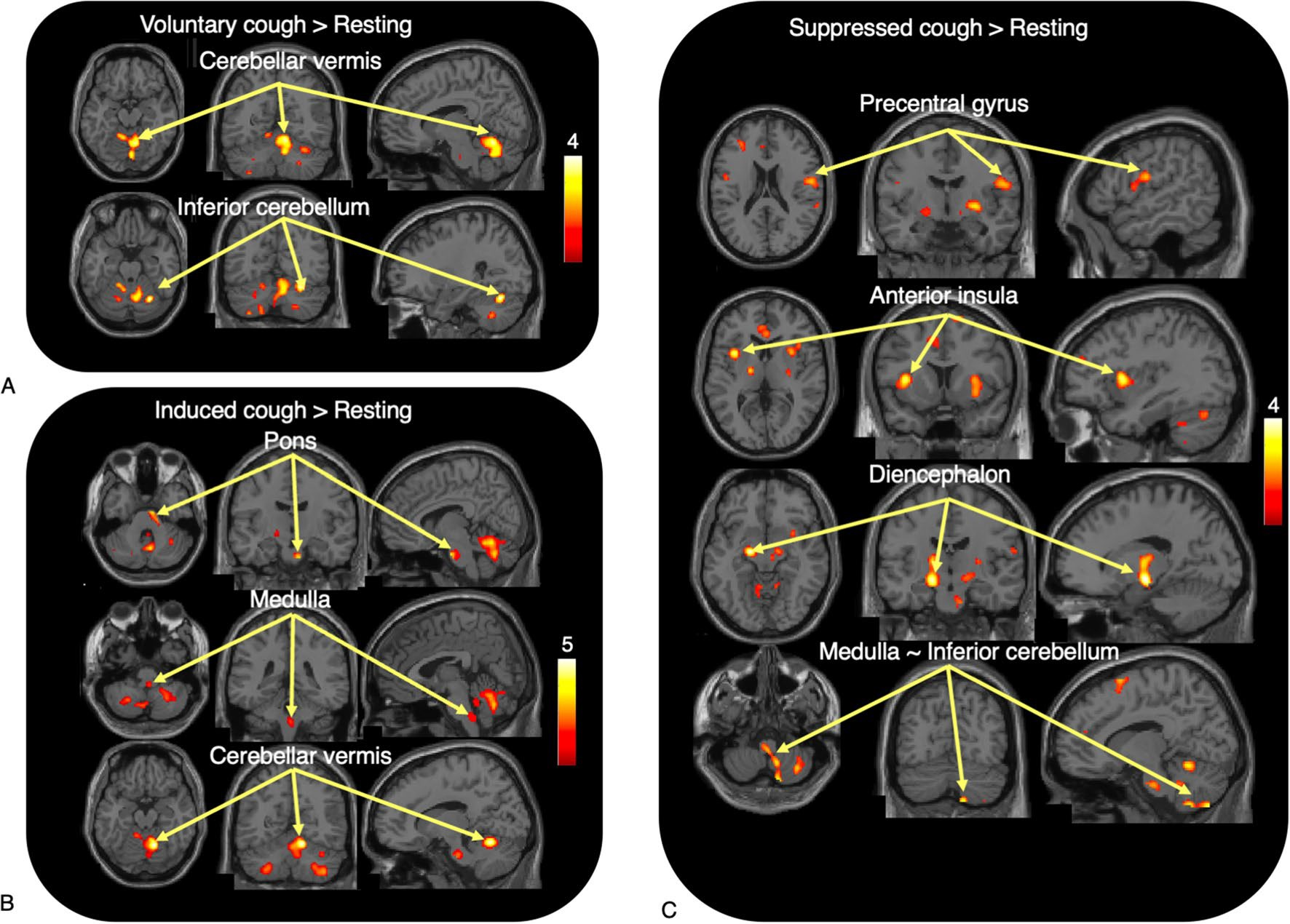 Statistical parametric mapping (SPM) results. Brain regions with significant activation in voluntary cough (A), induced cough (B), and suppressed cough (C) compared with rest. Image courtesy of Scientific Reports.