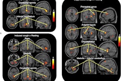 Statistical parametric mapping (SPM) results. Brain regions with significant activation in voluntary cough (A), induced cough (B), and suppressed cough (C) compared with rest. Image courtesy of Scientific Reports.