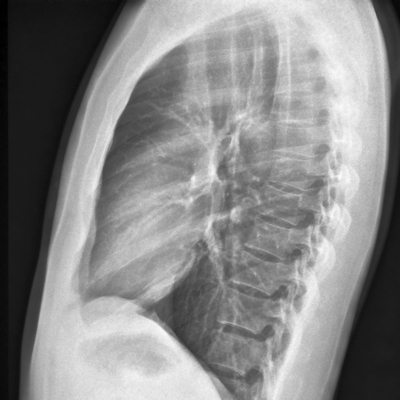 Chest X Ray Lateral View 400
