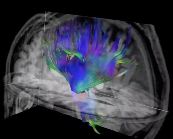 Researchers used diffusion-tensor imaging, an MRI technique, to study the impact of soccer heading on the brain. This method tracks the microscopic movement of water molecules through brain tissue to characterize the brain's microstructure. Image and caption courtesy of the RSNA.
