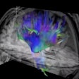 Researchers used diffusion-tensor imaging, an MRI technique, to study the impact of soccer heading on the brain. This method tracks the microscopic movement of water molecules through brain tissue to characterize the brain's microstructure. Image and caption courtesy of the RSNA.