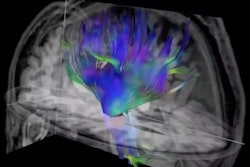 Researchers used diffusion-tensor imaging, an MRI technique, to study the impact of soccer heading on the brain. This method tracks the microscopic movement of water molecules through brain tissue to characterize the brain's microstructure. Image and caption courtesy of the RSNA.