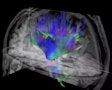 Researchers used diffusion-tensor imaging, an MRI technique, to study the impact of soccer heading on the brain. This method tracks the microscopic movement of water molecules through brain tissue to characterize the brain's microstructure. Image and caption courtesy of the RSNA.