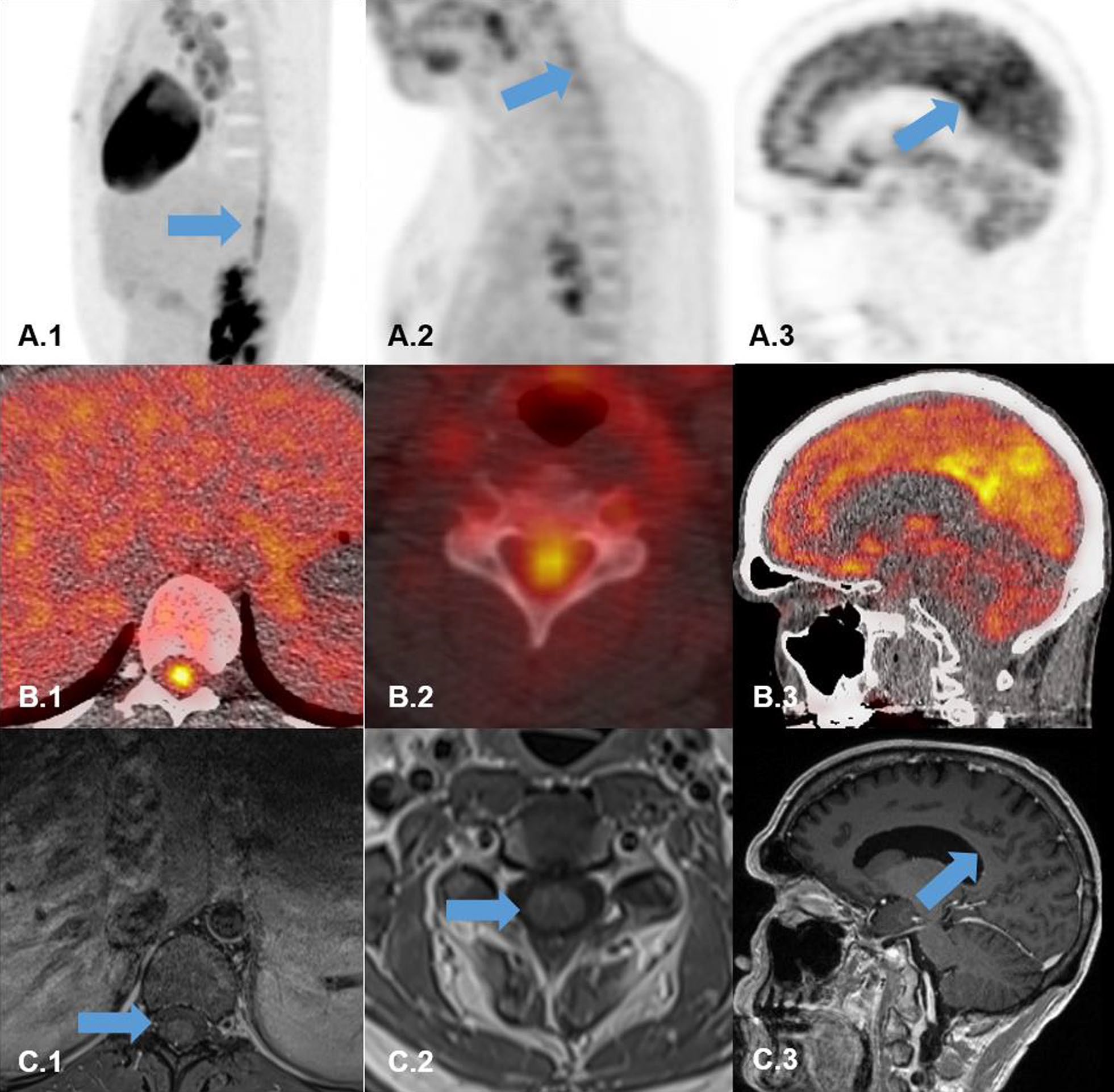 F-18 FDG-PET and MRI scans of three patients. (A.1-B.1) F-18 FDG-PET (A1 sagittal PET; B1 transaxial fused PET/CT) showing intense hypermetabolism in the lower thoracical spinal cord (blue arrow). (C.1) Transaxial MRI-scan (T1_TSE_FS) showing no abnormal gadolinium enhancement in the lumbar spinal cord (blue arrow). (A.2-B.2) F-18 FDG-PET (A2 sagittal PET; B2 transaxial fused PET/CT) showing hypermetabolism in the cervical spinal cord (blue arrow). (C.2) Transaxial MRI scan (T1_TSE_FS) showing no abnormal gadolinium enhancement in the cervical spinal cord (blue arrow). (A.3-B.3) F-18 FDG-PET (A3 sagittal PET; B3 transaxial fused PET/CT) showing bilateral hypermetabolism the precuneus region (blue arrow). (C.3) Transaxial MRI scan (T1_MPRAGE) showing no abnormal gadolinium enhancement in precuneus region (blue arrow). Image courtesy of Neurological Research and Practice.
