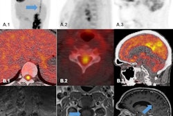 F-18 FDG-PET and MRI scans of three patients. (A.1-B.1) F-18 FDG-PET (A1 sagittal PET; B1 transaxial fused PET/CT) showing intense hypermetabolism in the lower thoracical spinal cord (blue arrow). (C.1) Transaxial MRI-scan (T1_TSE_FS) showing no abnormal gadolinium enhancement in the lumbar spinal cord (blue arrow). (A.2-B.2) F-18 FDG-PET (A2 sagittal PET; B2 transaxial fused PET/CT) showing hypermetabolism in the cervical spinal cord (blue arrow). (C.2) Transaxial MRI scan (T1_TSE_FS) showing no abnormal gadolinium enhancement in the cervical spinal cord (blue arrow). (A.3-B.3) F-18 FDG-PET (A3 sagittal PET; B3 transaxial fused PET/CT) showing bilateral hypermetabolism the precuneus region (blue arrow). (C.3) Transaxial MRI scan (T1_MPRAGE) showing no abnormal gadolinium enhancement in precuneus region (blue arrow). Image courtesy of Neurological Research and Practice.