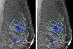 Radiology Ai Mammo
