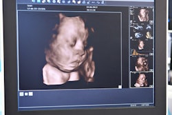 Ultrasound 3 D Fetal Head 400