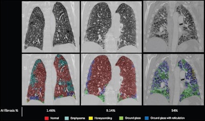 Examples of degrees of fibrosis quantified and radiologically scored. CT pulmonary angiograms (top row) were radiologically scored as having mild (left), moderate (middle), and severe (right) disease; the corresponding output and fibrosis percentage as quantified by the artificial intelligence (AI) model are shown in the bottom row. Images courtesy of the RSNA.