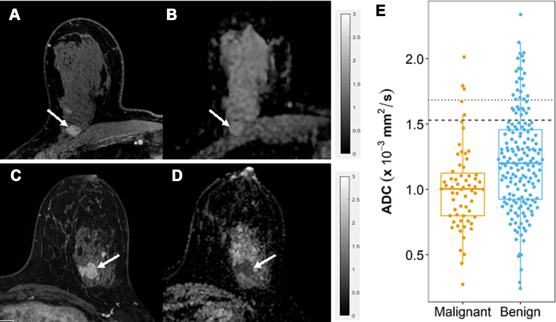 Apparent diffusion coefficient (ADC) measurements for benign and malignant BI-RADS category 4 or 5 lesions at MRI. (A, B) Benign BI-RADS category 4 lesion in a 55-year-old woman. (A) Dynamic contrast-enhanced MRI (DCE-MRI) scan shows a 12-mm, oval, circumscribed, homogeneous mass in the right posterior breast (arrow). (B) On the diffusion-weighted image, the lesion shows high diffusivity (arrow), with an ADC of 2.04 &times; 10-3 mm2/sec. Biopsy revealed benign fibroadenoma. (C, D) Malignant BI-RADS category 4 lesion in a 41-year-old woman. (C) DCE-MRI scan shows a 24-mm irregular, heterogeneous mass at the 3 o&rsquo;clock position in the left breast (arrow). (D) On the diffusion-weighted image, the lesion demonstrates low diffusivity (arrow), with an ADC of 0.91 &times; 10-3 mm2/sec. Biopsy revealed invasive ductal carcinoma. All MRI scans are shown in the axial plane. (E) Box plot shows ADC measurements for 240 BI-RADS 4 and 5 lesions (63 malignant and 177 benign). Both prespecified optimal and conservative ADC cutoffs are indicated on the plot for reference: 1.53 &times; 10-3 mm2/sec (dashed line) and 1.68 &times; 10-3 mm2/sec (dotted line), respectively. All ADCs were calculated with maximum b value of 800 sec/mm2. The midline of each box shows the median value, and the box extends from first to third quartiles. The whiskers extend from the first and third quartiles to the smallest and largest values, respectively, if those values are within 1.5 times the IQR. If not, the length of the whiskers is limited to 1.5 times the IQR. Image courtesy of the RSNA.